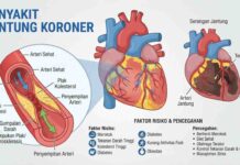 Penyakit Jantung Koroner: Penyebab, Gejala, Faktor Risiko, Pencegahan, dan Pengobatan